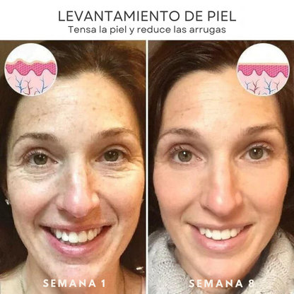 Suero facial Botox